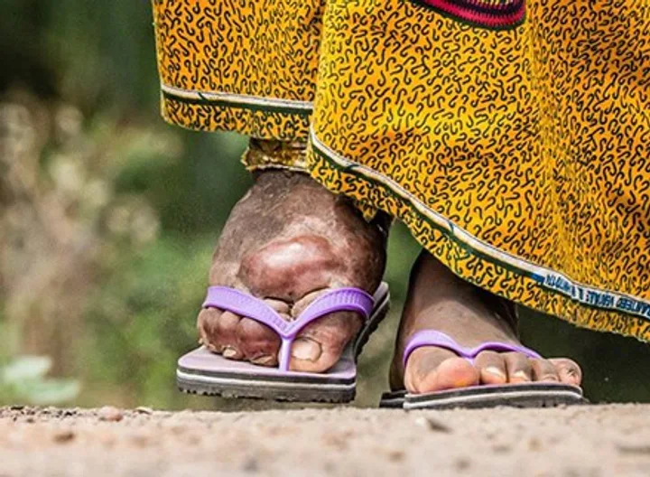 Recommendations for rapid diagnosis of filariasis