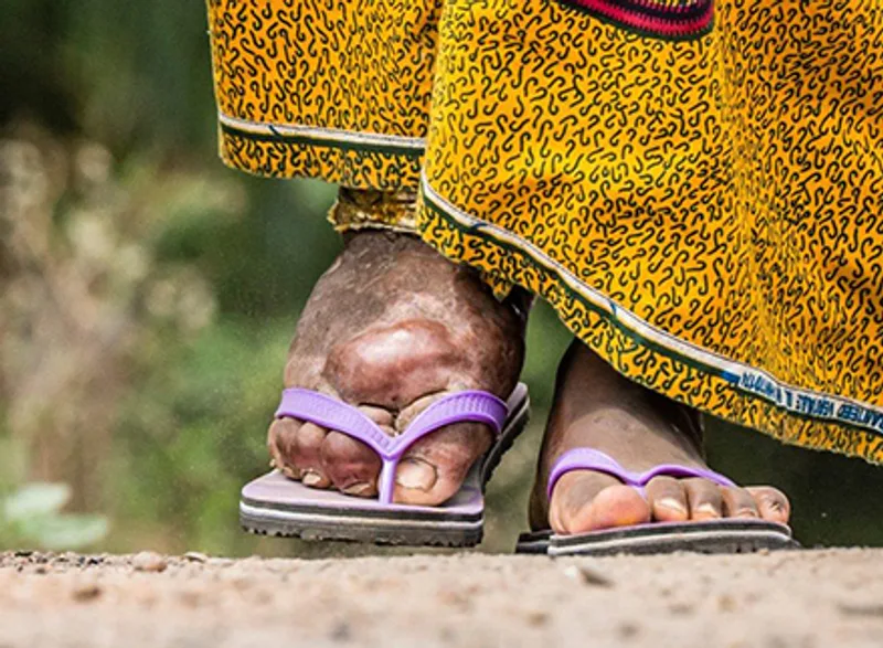 togo-lymphatic-filariasis.tmb-1920v